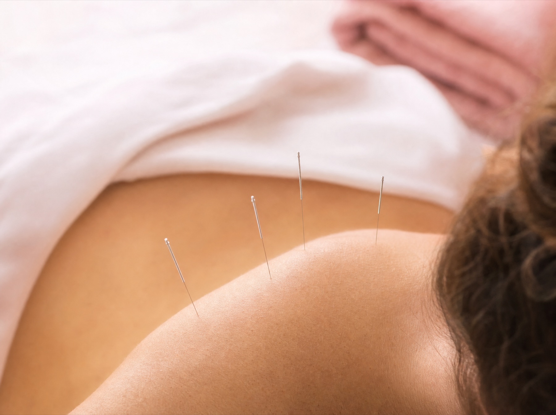 Close-up of sterile, hair-thin acupuncture needles placed on the upper back during a treatment session at Horizon Wellness